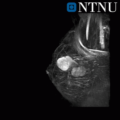 Breast Cancer GIF. This 496 x 498 animated GIF is part of our cancer de mama collection. Created by ntnuisb. View the original animation, share it, or…