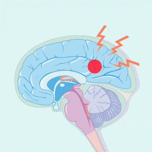 Brain Aneurysm Surgery Lagos GIF