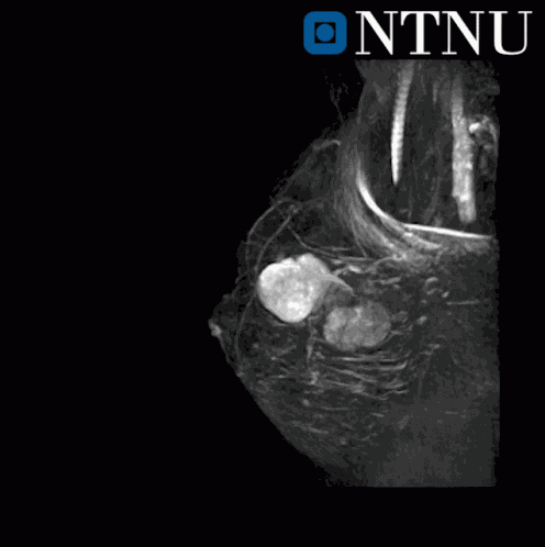 Breast Cancer GIF
