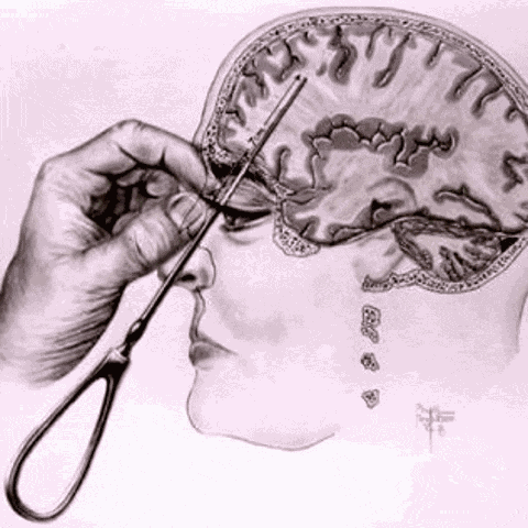 Lobotomy GIF