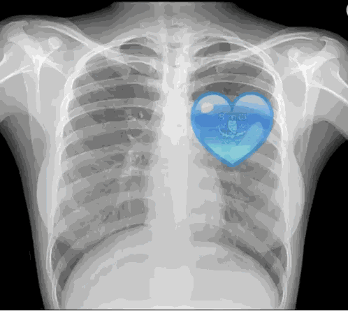 X Ray Beating GIF